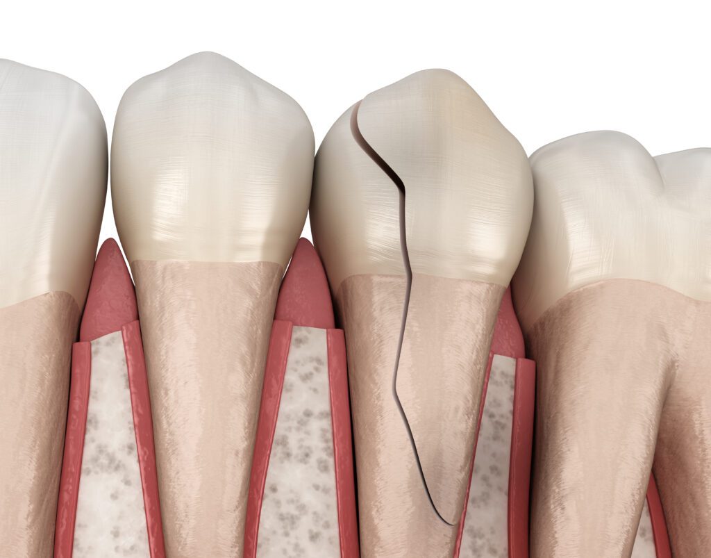 tooth repair Falls Church, cracked tooth repair